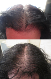 PRP Hair Loss Treatment For Men